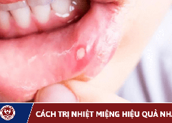 Cách Trị Nhiệt Miệng Nhanh Chóng, Hiệu Quả Tại Nhà
